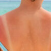 Sunburn Treatment and Prevention Facts